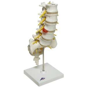 3B Scientific A76/5 Lumbar Spinal Column with Dorso Lateral Prolapsed 